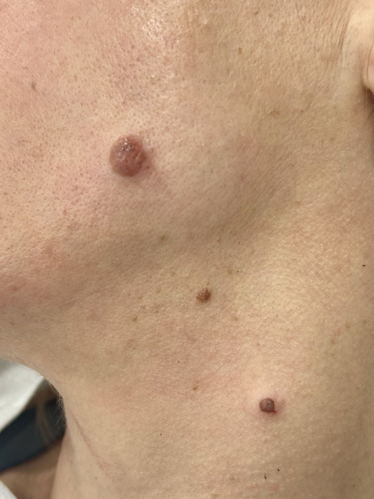 cirugia lesiones cutaneas