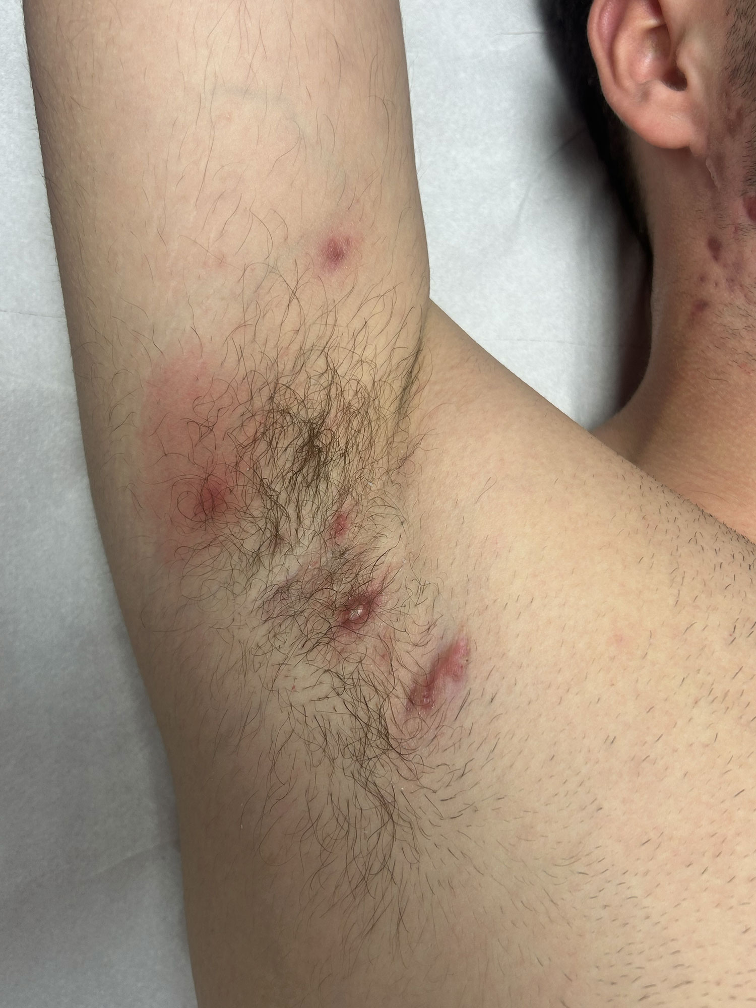 hidradenitis