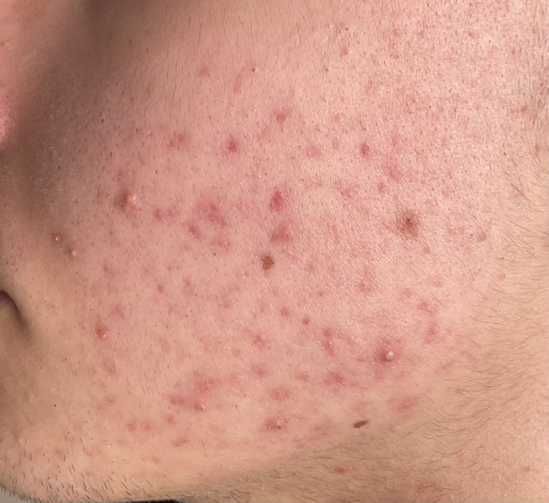 ines acne ines acne