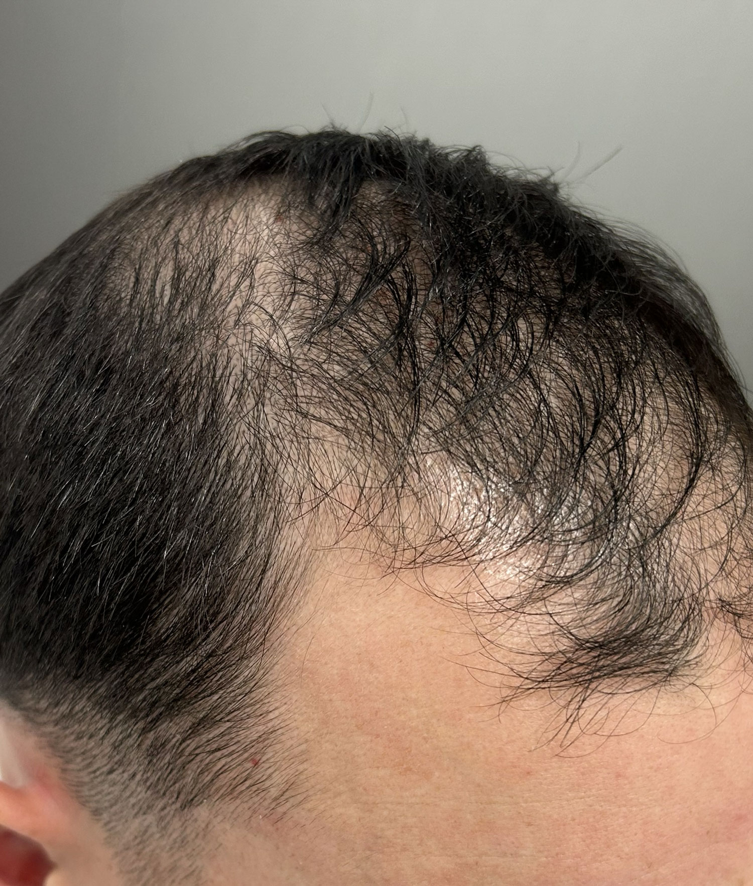 ines alopecias ines alopecias