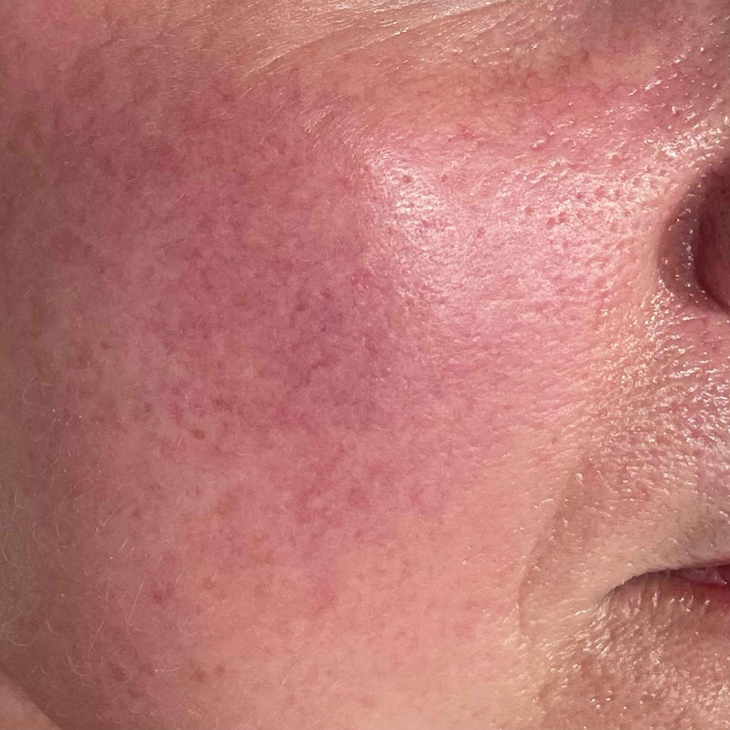 ines rosacea ines rosacea