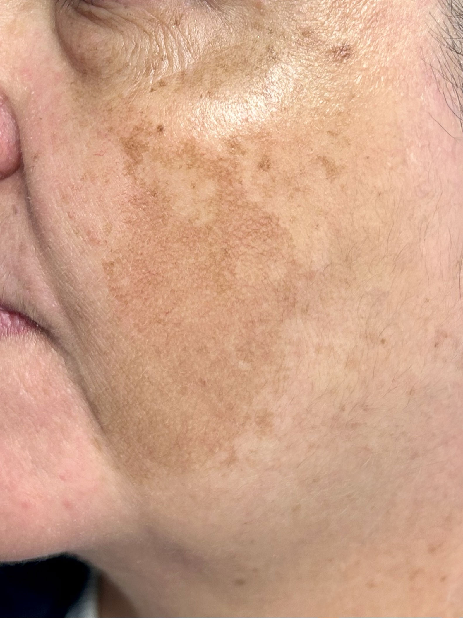 melasma ines melasma ines